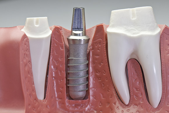 implantes dentales