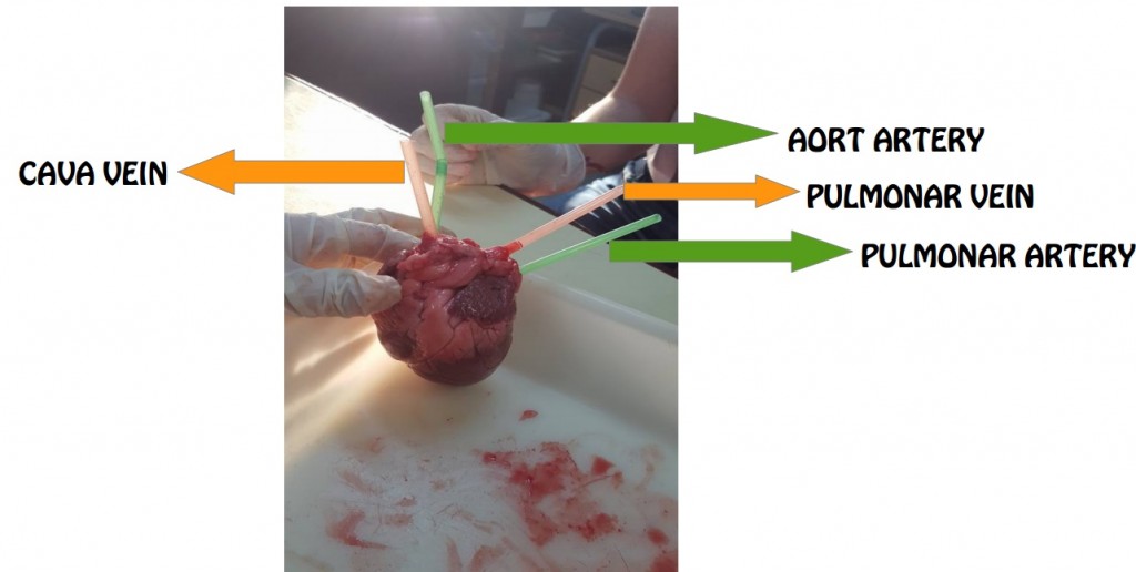 disections heart