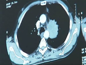 cancerpulmo
