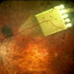 implante_electronico_retina