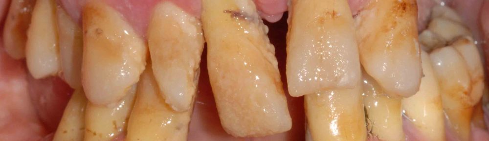 piorrea causas síntomas fp higiene bucodental